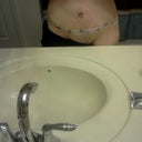 Post op day 6  drain out