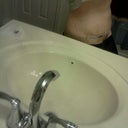 Post op day 6. Drain out
