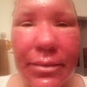 48 hours after fraxel