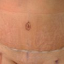 post op day 3