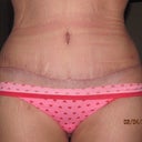 1 month post op