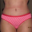 1 month post op