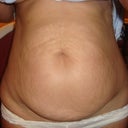 Tummy Tuck pre op, front view