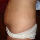 Tummy Tuck pre op, side view