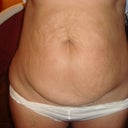 Tummy tuck pre op, front view