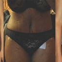 Front comparison photos: Pre-Op, 5 days and 4 weeks.