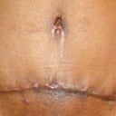 Yes, scar at 4 weeks...still pretty frankenstein.