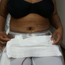 Post op day 3 front view