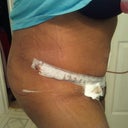 day 3 side view---very swollen
