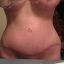 8 weeks post op.."the scar" still bright red!! I hope that it doesn't stay this red!!!