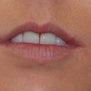 Alloderm Lip Implants