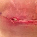 Left hip scar - Day 13 Post Op