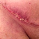 Right groin scar - Day 13 Post Op