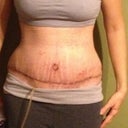 Day 10 Post Op.  Rash from my binder/garmet.  Heat related???