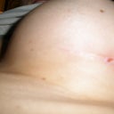 Left Breast Day 25