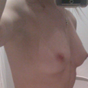 Pre op 34 A side view