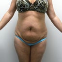 Before tummy tuck surgery