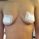 Front 1 day after removal of implants