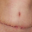 4 weeks PO - disappointed in how rough the scar still looks.