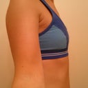 Before - Side View