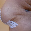 Breasts 2 weeks post Ultimate Breast Lift