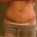 10wks post op