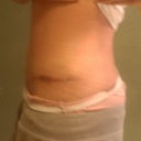 10wks post op........my left hip is finally healing really good after that stitch came out