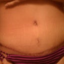 10wks post op.......my right hip is alittle swollen still but the left side is finally completely flat.....and i have the swimsuit bottom pulled down to show the scar