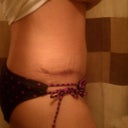 10wks post op.......this it my right hip, you can really see how it was swollen alittle