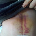 Look how tight he pulled my abs you can see by the bruise line. Feels like I have done a thousand press ups !