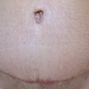 5 weeks post op. TT scar.