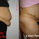 Side Before and After