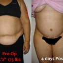 Front Before and After