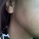 Test patch 10/28/11. No adverse reaction 2 days after.