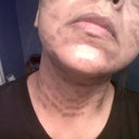 Face & Neck Day after IPL 11/19/11