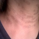 Neck - 1 month after procedure 12/16/11