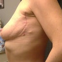 1 month post op