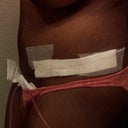 The left side post-op day 2