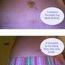 These are my incisions.  Extremely small.