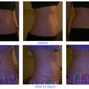 3 days after smart lipo.  I will take more pictures this week.