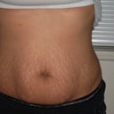 front view of tummy: 9 days before surgery