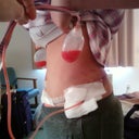 this us my side view the day of surgery. sorry about all the drains.