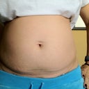 Before surgey....white wide belly