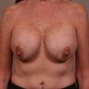 Implants With Lift