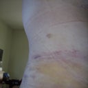 some of the bruising to my flanks that wasn't even there until yesterday.  The other side, my back and one side of my butt look a bit worse.  Doesn't bother me at all...am so glad he did some lipo to help blend/contour my belly into my upper hip/flanks.  It's ouchy, but no big deal.