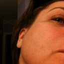 Right side before procedure