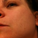 Left side before procedure