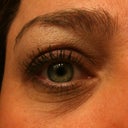 Right eye Two weeks after treatment