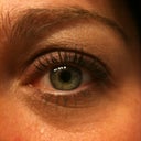 Left eye Two weeks after treatment