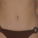before coolsculpting